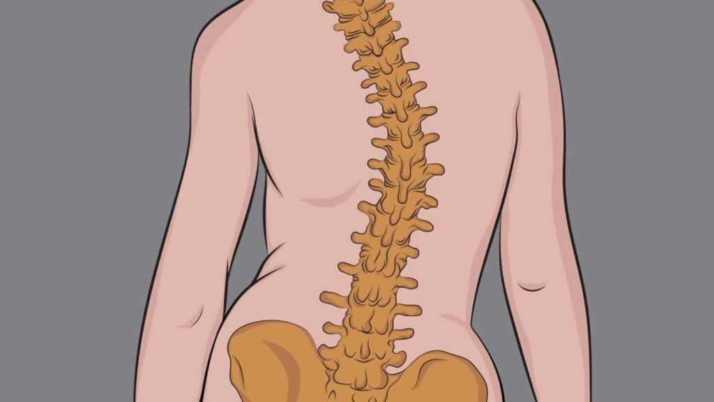 Conheça os tipos de escoliose e porque procurar um especialista em coluna