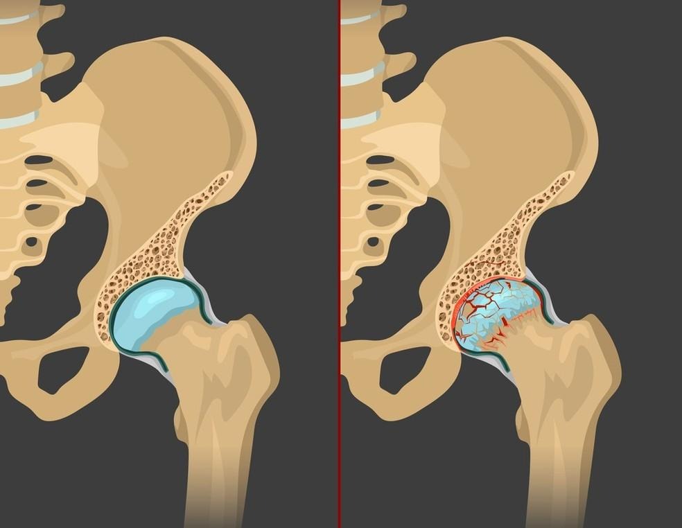 Artrose do quadril: sintomas, causas e opções de tratamento