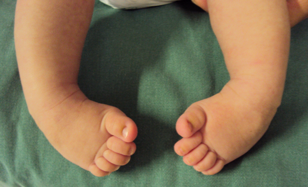 O que é pé torto congênito? Sintomas, causas e como tratar