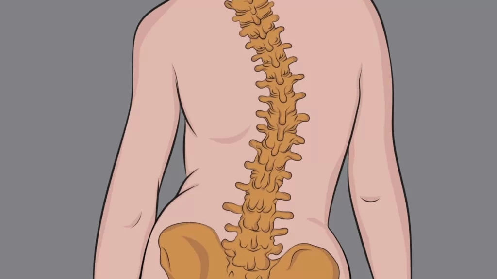 Conheça os tipos de escoliose e porque procurar um especialista em coluna