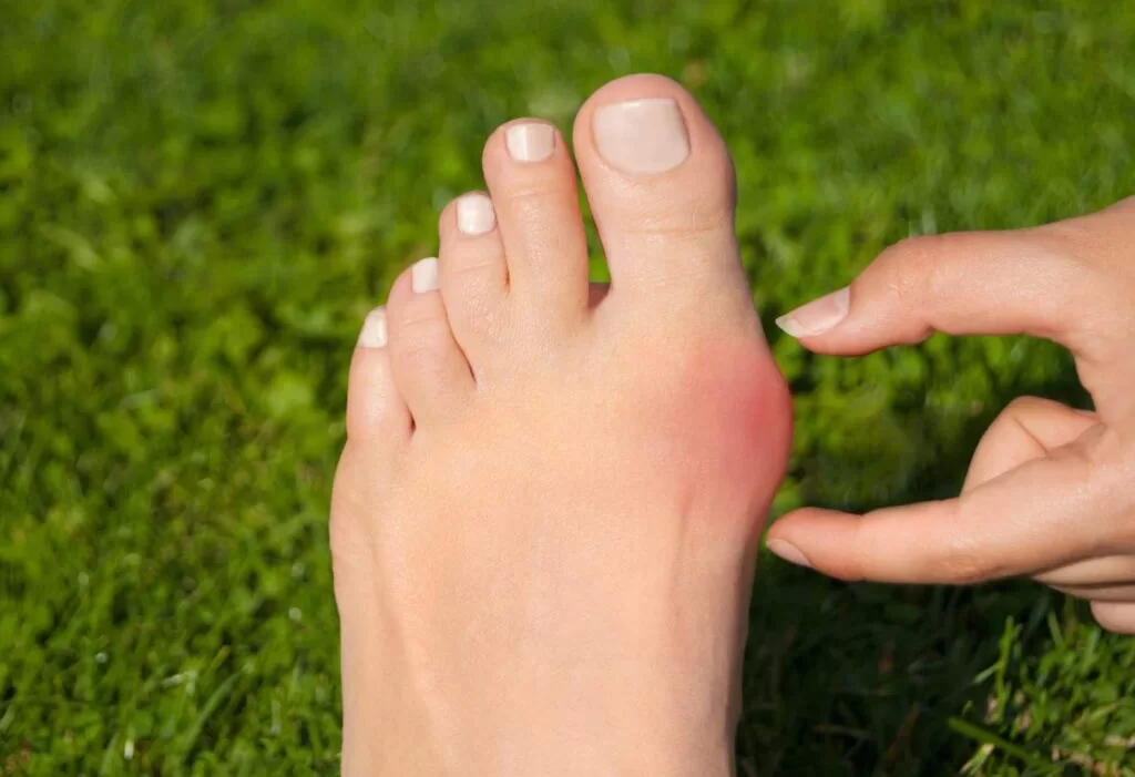 Como prevenir joanete