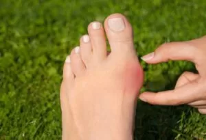 Como prevenir joanete